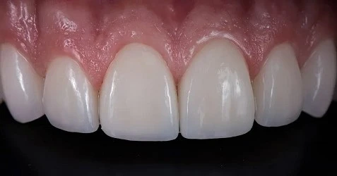 We Welcome You To Learn About Porcelain Veneers and Our Smile Makeover