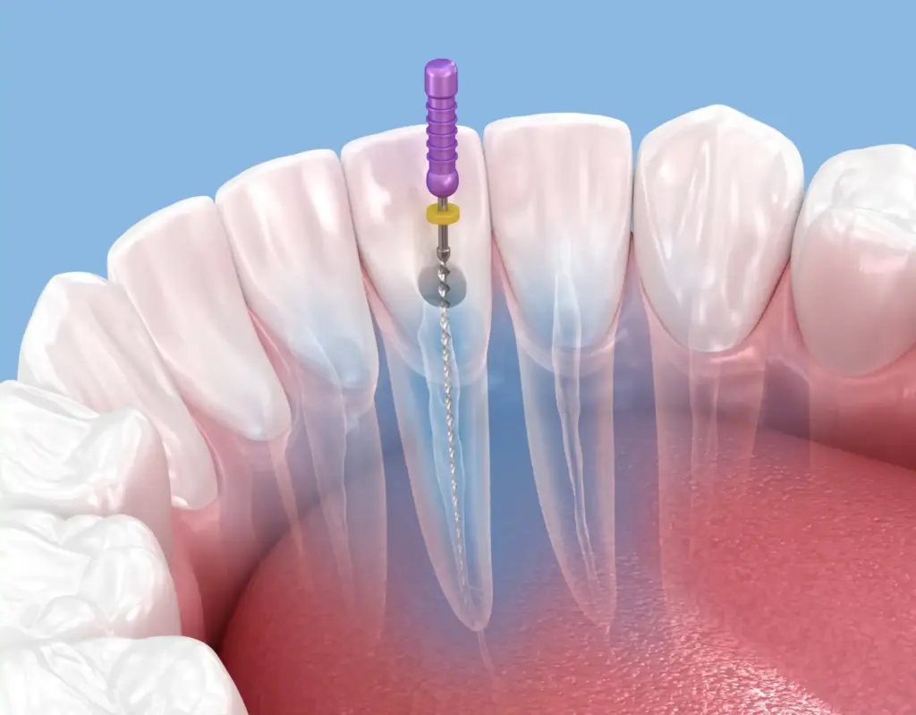 Dental implant procedure illustration with crown