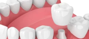 dental implants in San Jose dentist