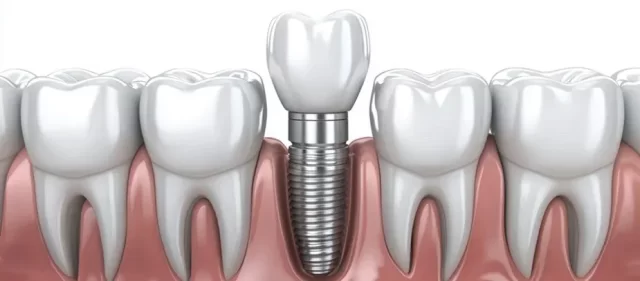 dental implants near you